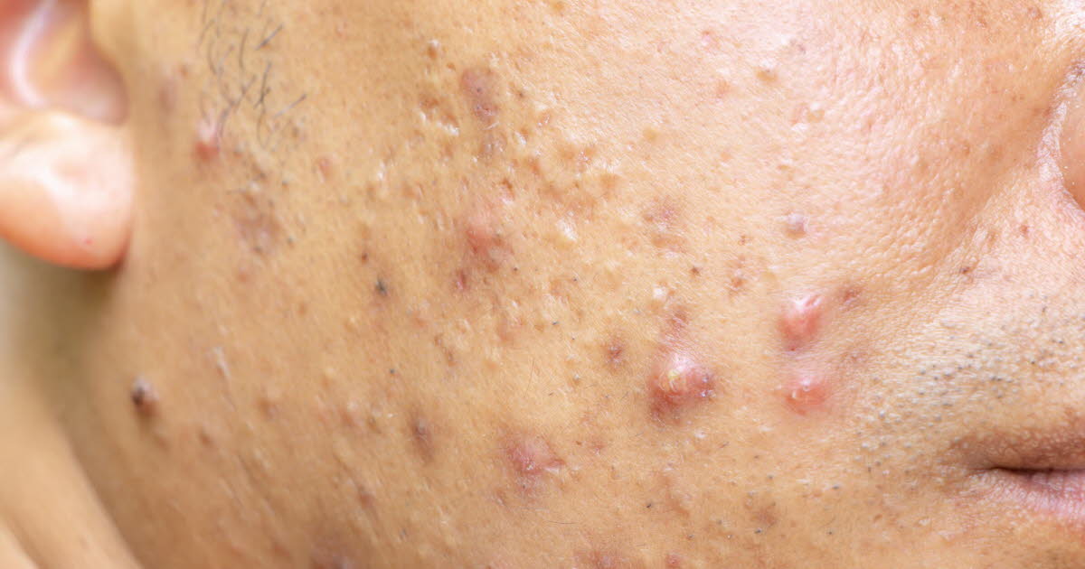 Well-being.  Acne: why is nearly one in five adults affected worldwide?