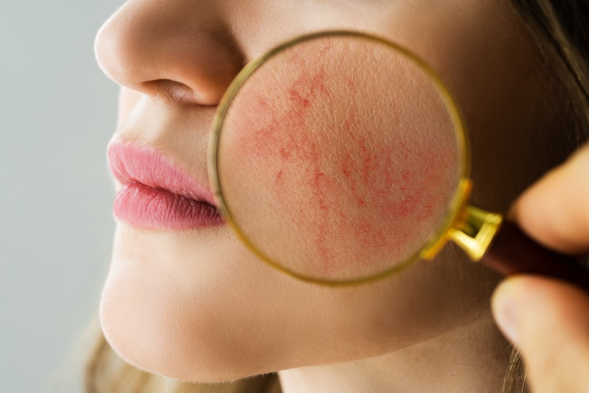 The different treatments for rosacea