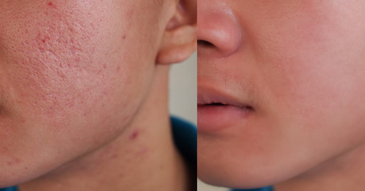 Well-being.  Acne: why is nearly one in five adults affected worldwide?